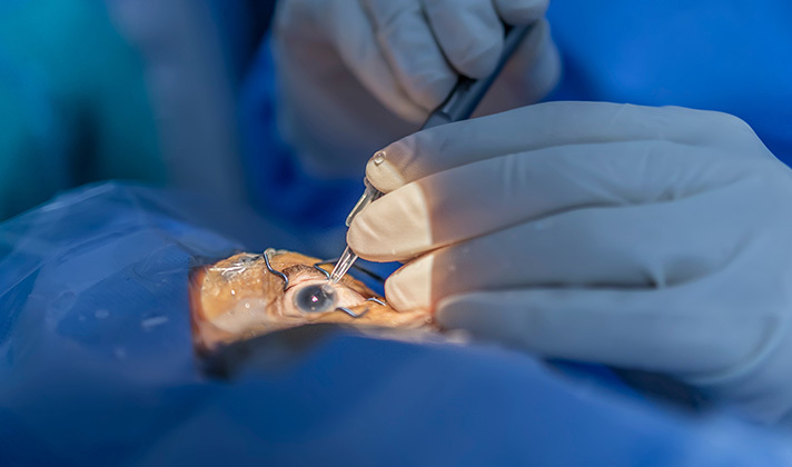 Après-midi de chirurgies de la cataracte