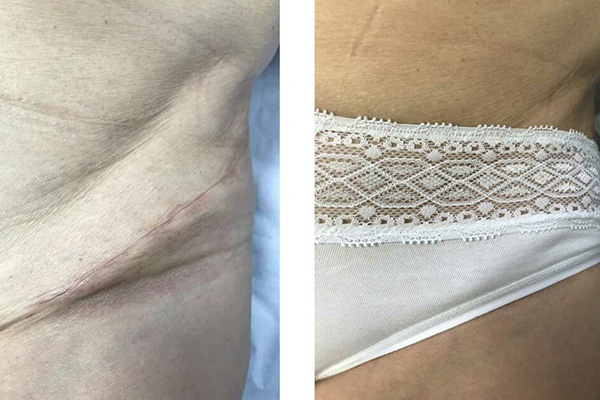 Prothèse totale de la hanche par voie bikini