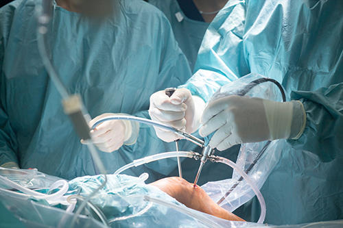 Chirurgie du ligament croisé antérieur (LCA)