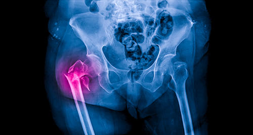 [REPORTÉ] Resurfaçage et arthroscopie de la hanche